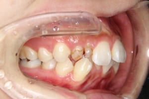 右上は犬歯が埋伏し、乳歯が二本残っています。